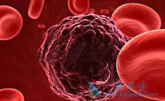 海外医疗的患者对于化疗没有那么排斥