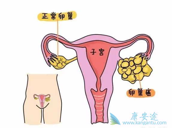 卵巢癌的早期症状 卵巢癌的早期症状