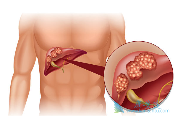 肝癌晚期症状 肝癌晚期症状