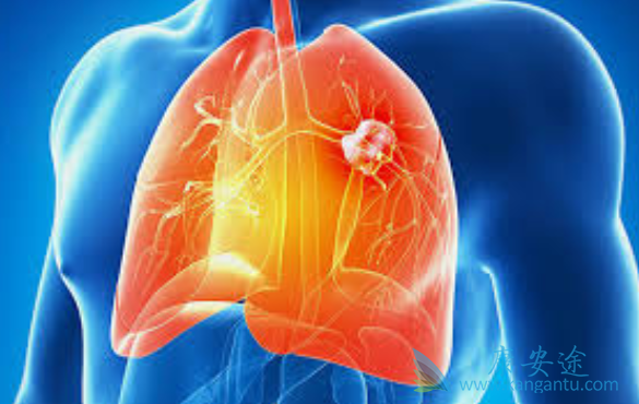 肺癌晚期治疗 肺癌晚期治疗