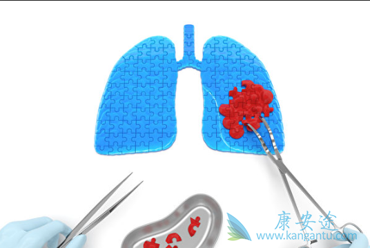 肺癌晚期能活多久 肺癌晚期能活多久