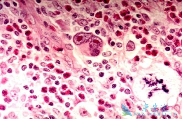 霍奇金淋巴瘤 霍奇金淋巴瘤