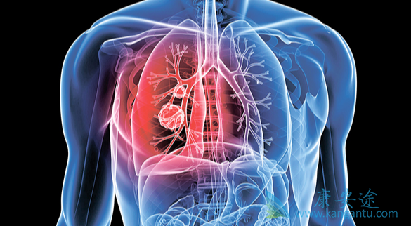 肺癌;肺癌的治疗 肺癌;肺癌的治疗