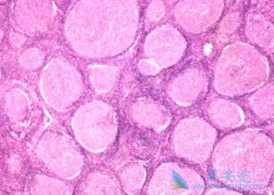 非霍奇金淋巴瘤 非霍奇金淋巴瘤