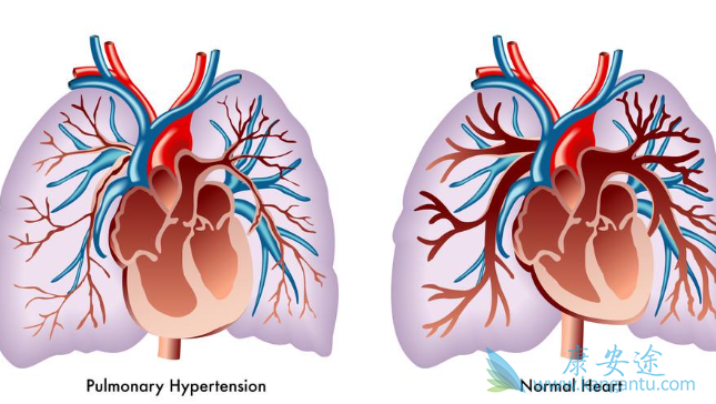 肺动脉高压 肺动脉高压